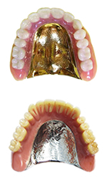 金属床義歯 画像