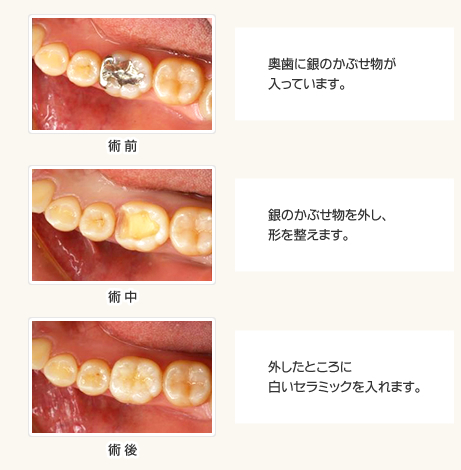 銀歯を白い歯に施術例